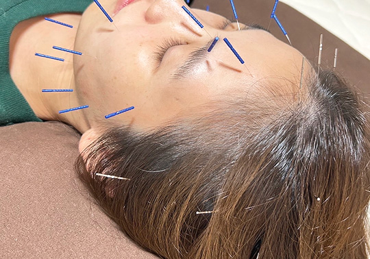 女性が横になり、頭と顔に鍼を受けている様子