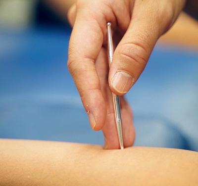 鍼を刺さずにケアする鍉鍼の施術をしている手元アップ