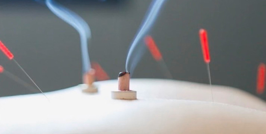 背中に置かれたお灸からやさしく煙が立ちのぼる様子