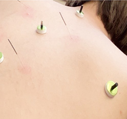 リラックスした状態で背中に鍼をしている様子