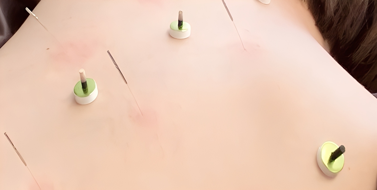 リラックスした状態で背中に鍼をしている様子