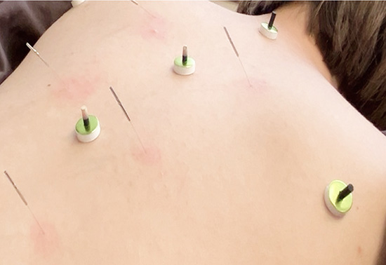 リラックスした状態で背中に鍼をしている様子